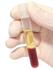 blood plasma sample