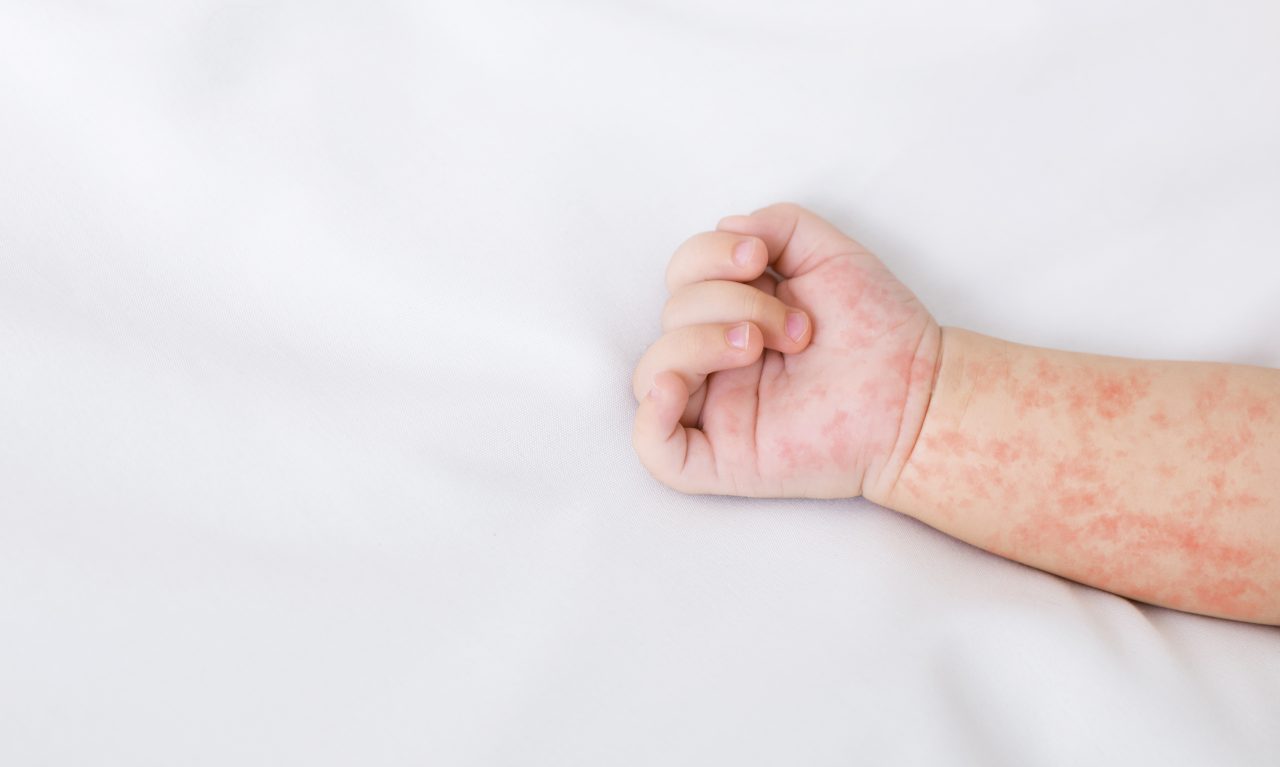 hand-of-newborn-baby-with-measles-rash-on-white-sh-2022-12-16-08-07-39-utc-1280x767.jpg