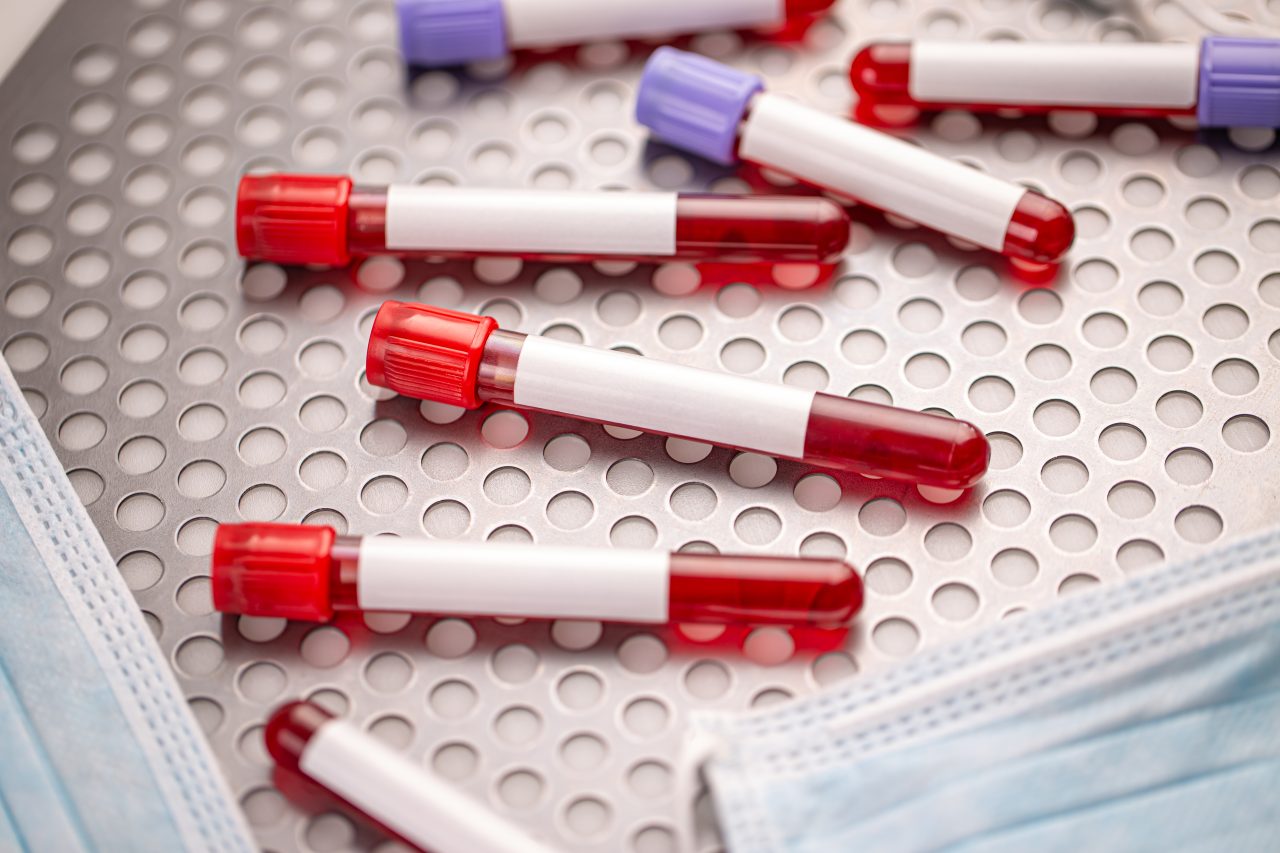 test-tubes-with-blood-samples-2021-08-27-14-32-57-utc-1280x853.jpg